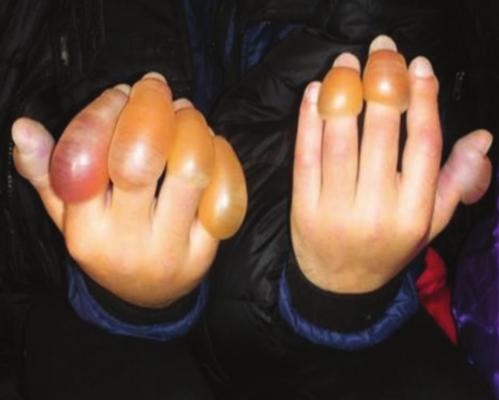 FROSTBITE injuries to the hands can be lifechanging. NATIONAL PARK SERVICE